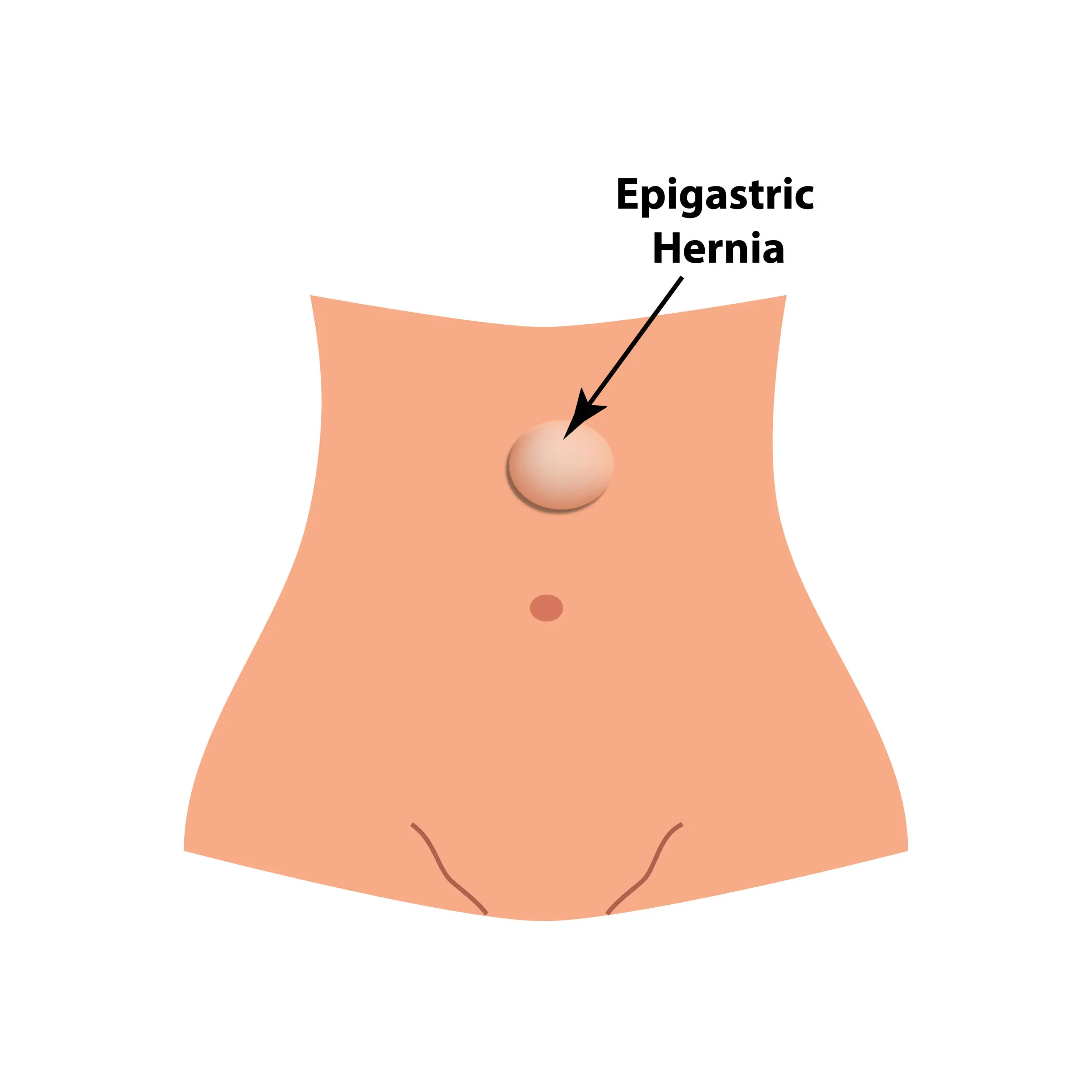 Symptoms & Coping Strategies for Epigastric Hernia